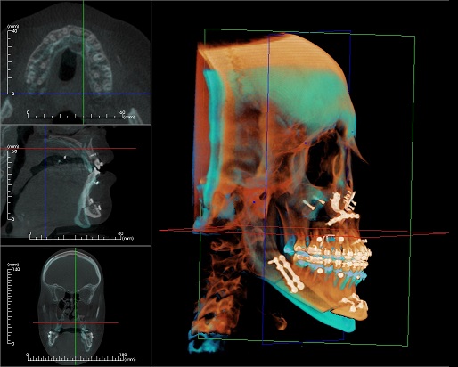 Surgical Treatments for OSA