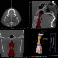 What is Upper Airway Resistance Syndrome (UARS)?